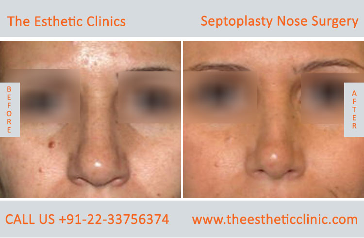 Septoplasty Nose Surgery before after photos in mumbai india (4)